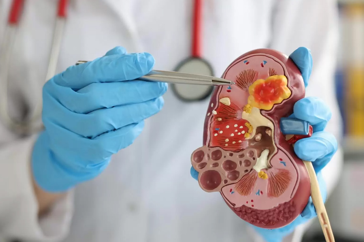 Böbrek Taşı Ameliyatı