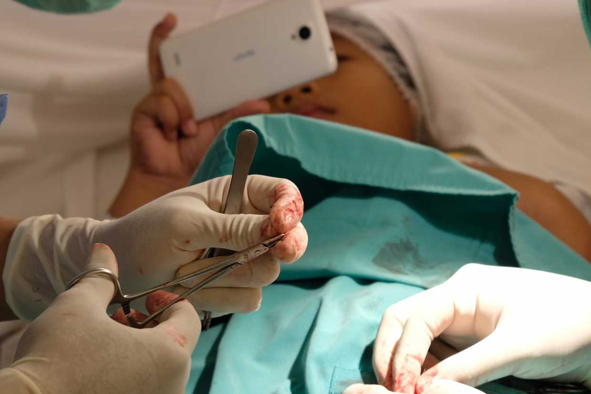 Hipospadias Ameliyatı